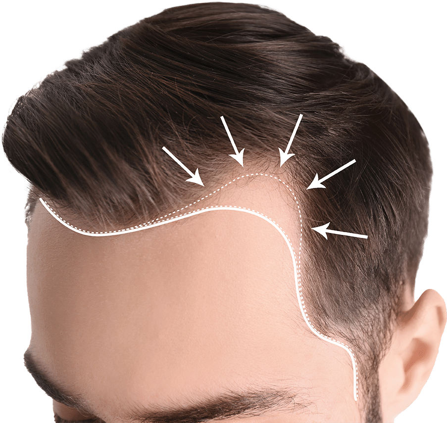 Micropigmentation-Rive-Sud-Restauration-Ligne-Cheveux